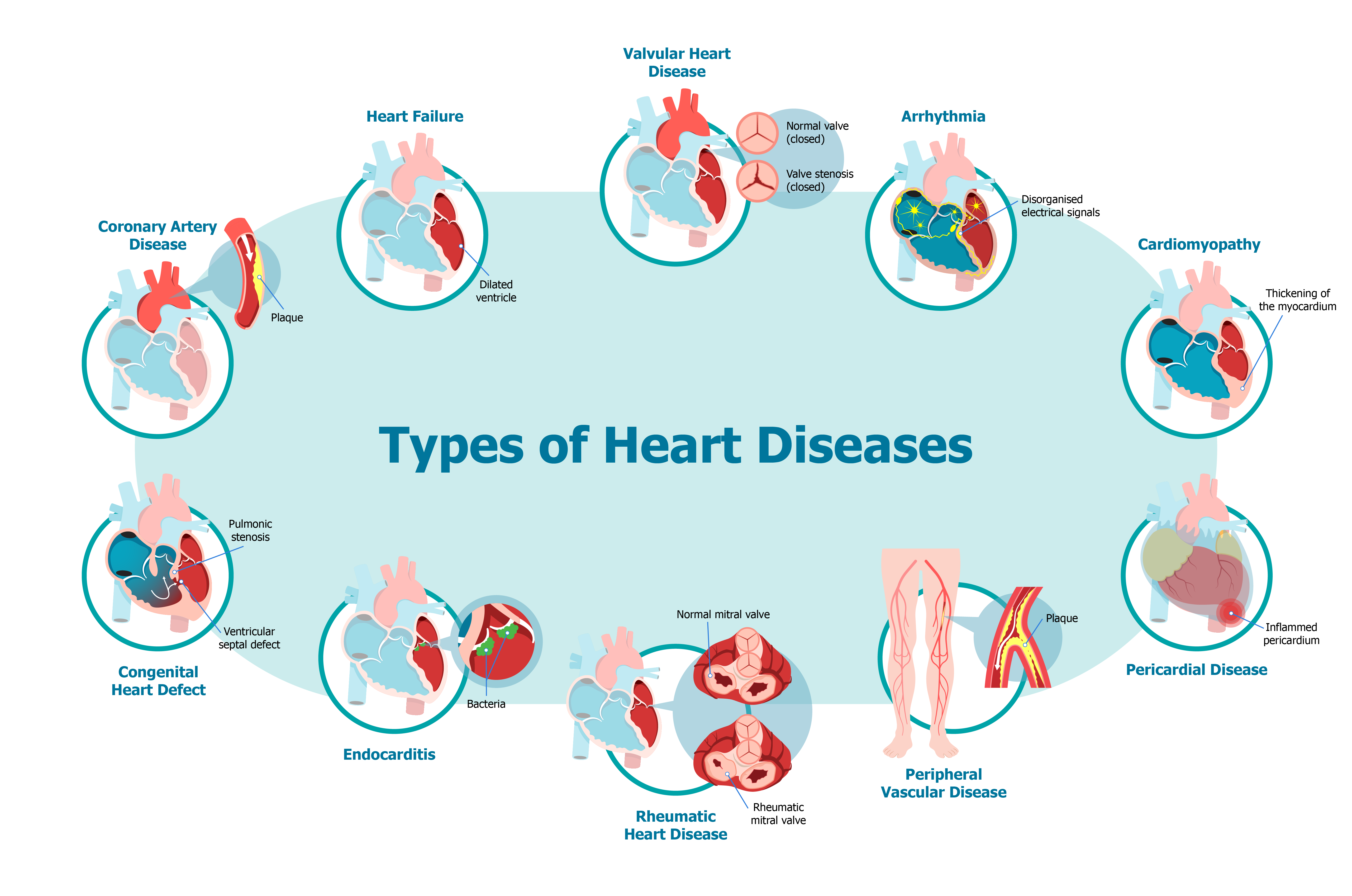 Types of heart diseases