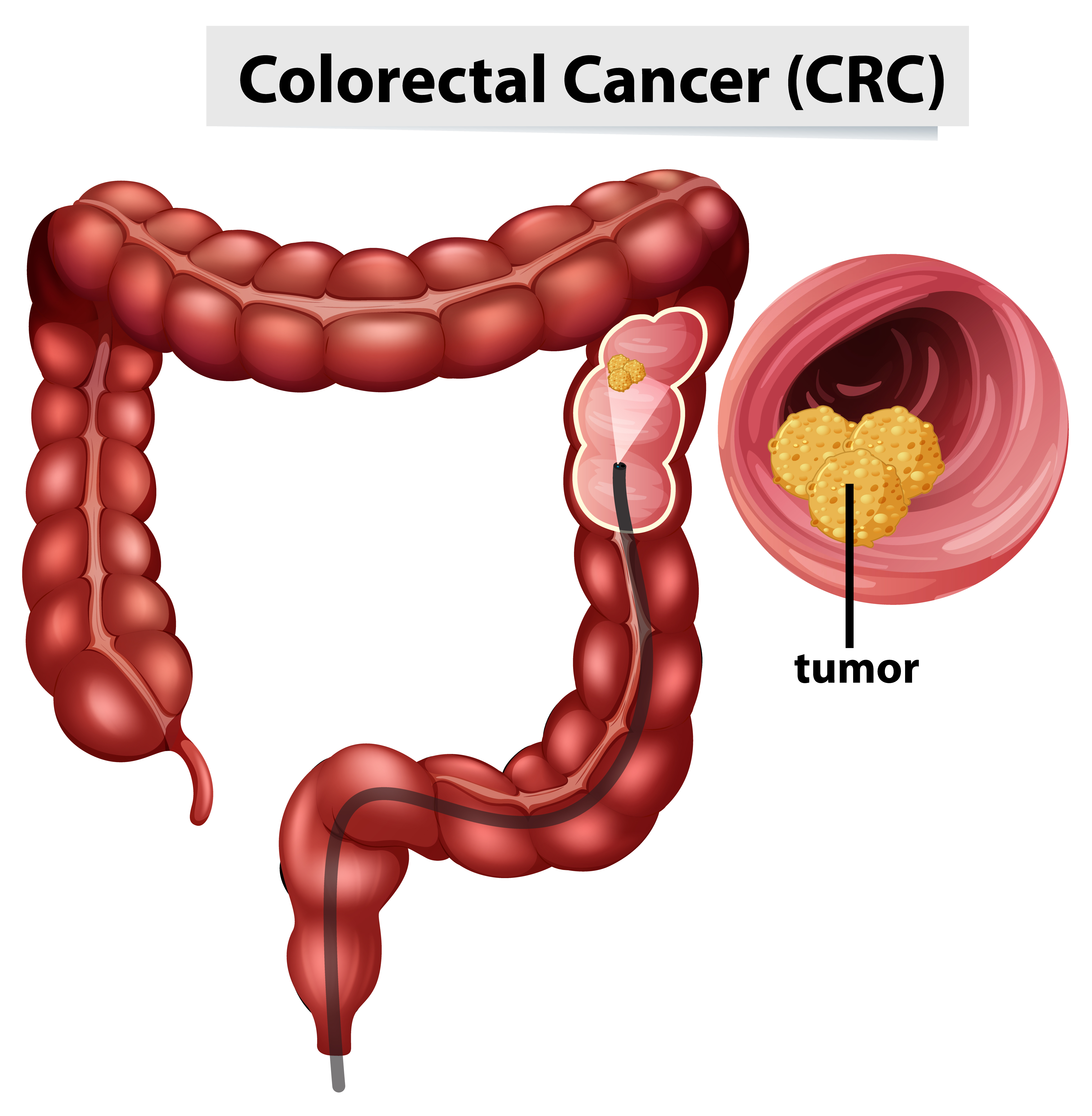 Colonoscopy for Colorectal Cancer
